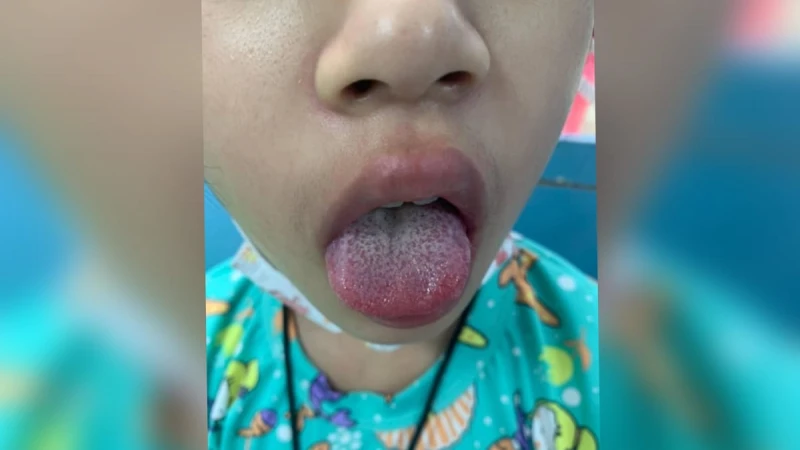 兒童確診冠病康復 泰醫生吁預防出現兒童多系統炎症綜合徵