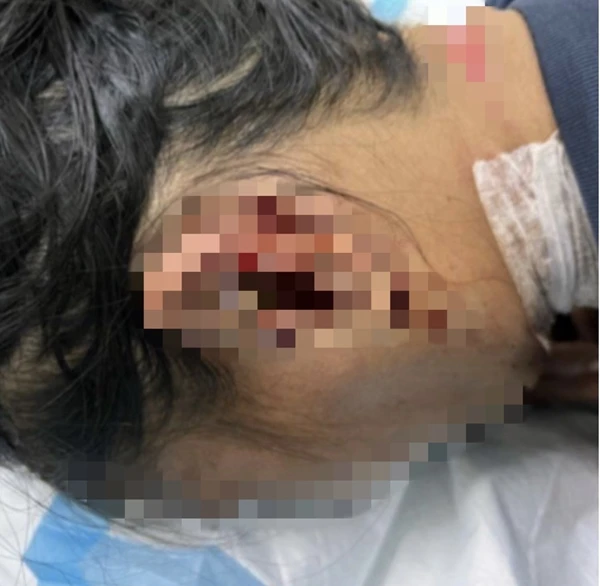 母親受重傷 6個月女嬰遭親戚砍死