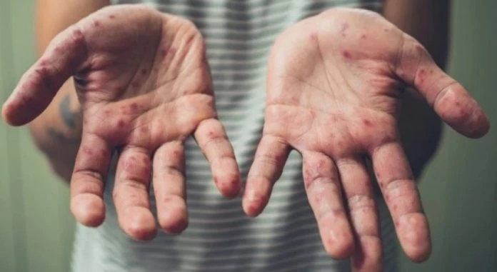 吉打手足口症病例有所增加　7天報102宗