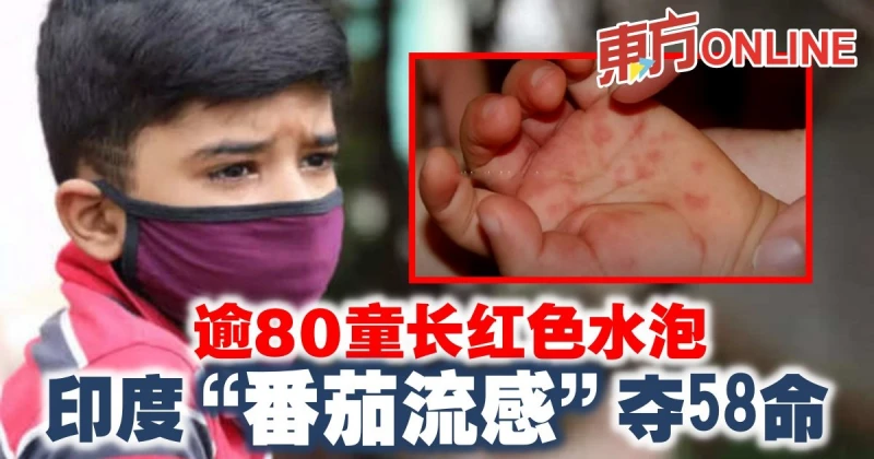 逾80童長紅色水泡　印度「番茄流感」奪58命