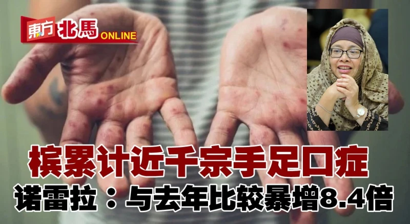 檳累計近千宗手足口症　與去年比較暴增8.4倍