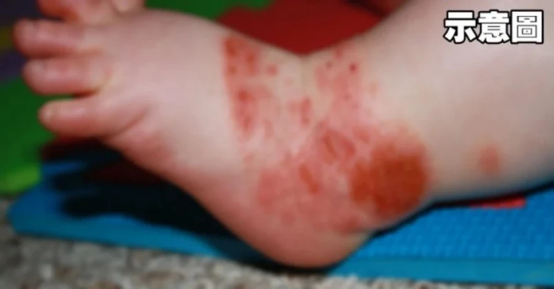 大馬多區手足口症大爆發 幼兒園業者受促留意