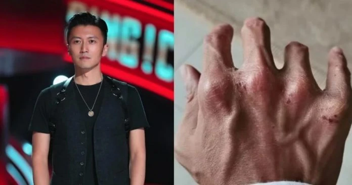 謝霆鋒拍戲受傷 指節變形全是傷痕 網心疼:保護好自己