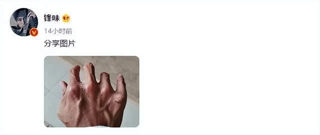 謝霆鋒拍戲受傷　指節變形全是傷痕　網心疼：保護好自己