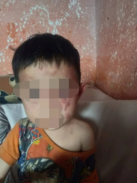 父母坐牢交監護人照顧 3歲華裔男童滿身傷