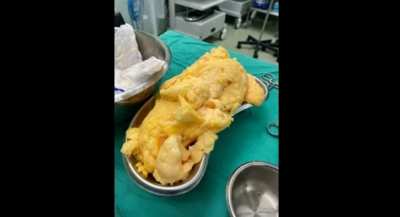 脂肪狀如榴槤、奶油、雞蛋! 民眾受促勿攝取過多卡路里