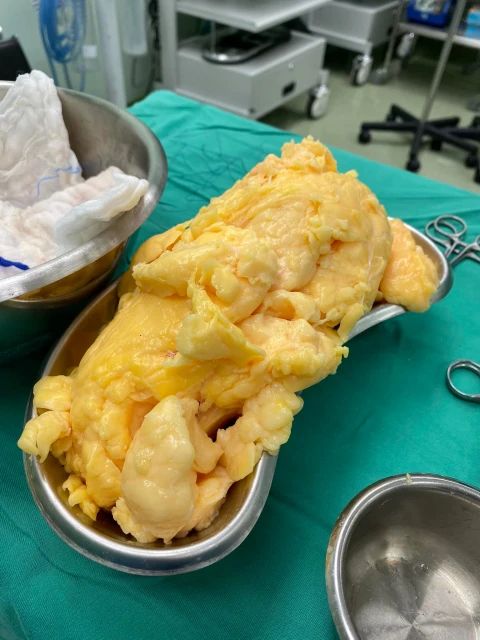 」這不是炒雞蛋「  醫生貼內脂肪圖警惕小心飲食