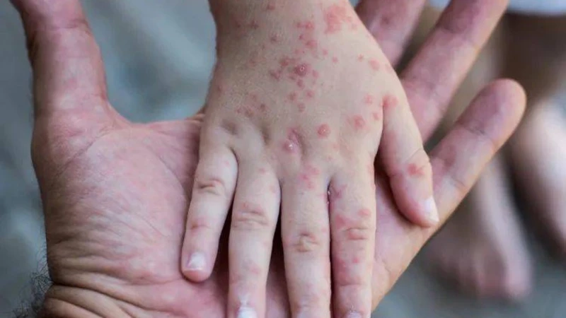 大馬手足口症病例暴增15倍  達令人擔憂水平！