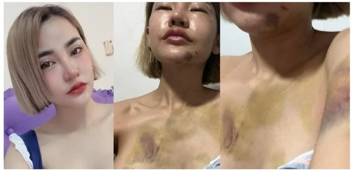 網紅不再隱忍家暴男友蹂躪    公布傷勢照自認遇人不淑