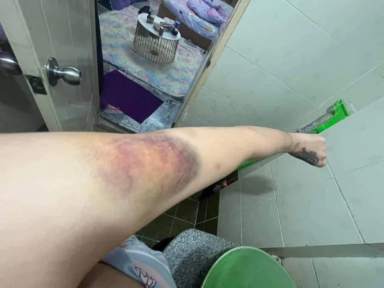 網紅不再隱忍家暴男友蹂躪    公布傷勢照自認遇人不淑