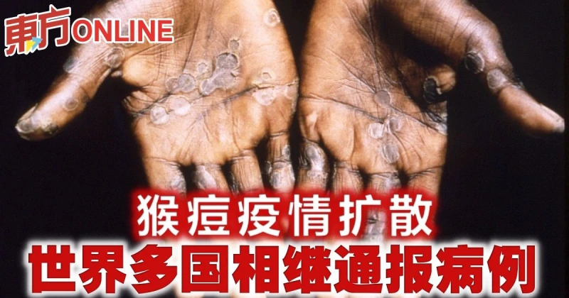 猴痘疫情擴散　世界多國相繼通報病例