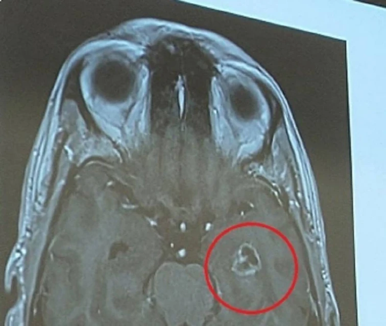 患罕見腦癌性情大變　男子動手術救回一命