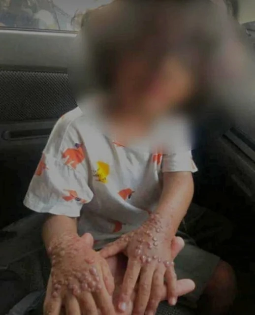 網傳孩童感染猴痘照片 衛部:未接獲任何病例若屬實應就醫