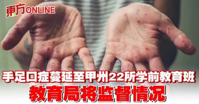 手足口症蔓延至甲州22所學前教育班　教育局將監督情況