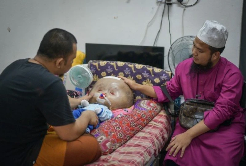 大馬「大頭娃娃」情況令人擔憂 專家受促協助治療