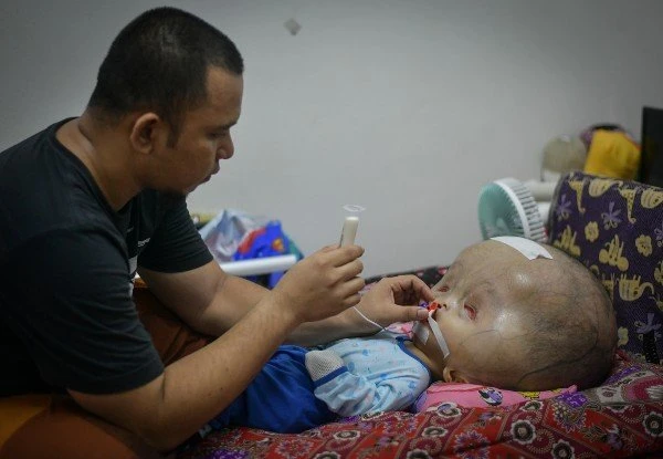 大馬「大頭娃娃」情況令人擔憂 專家受促協助治療