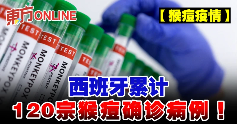 【猴痘疫情】西班牙累計120宗猴痘確診病例