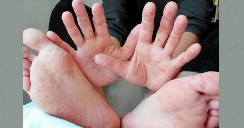 截至5月30日7萬1471手足口症病例　比去年同期暴增28倍