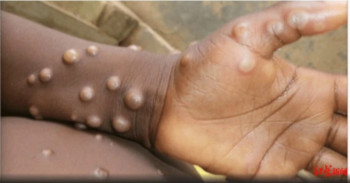 泰國已發現猴痘病毒 吉打入境旅客需檢測