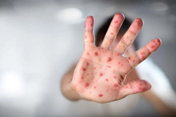 柔州手足口症累計5234宗　與去年同時期相比激增50倍