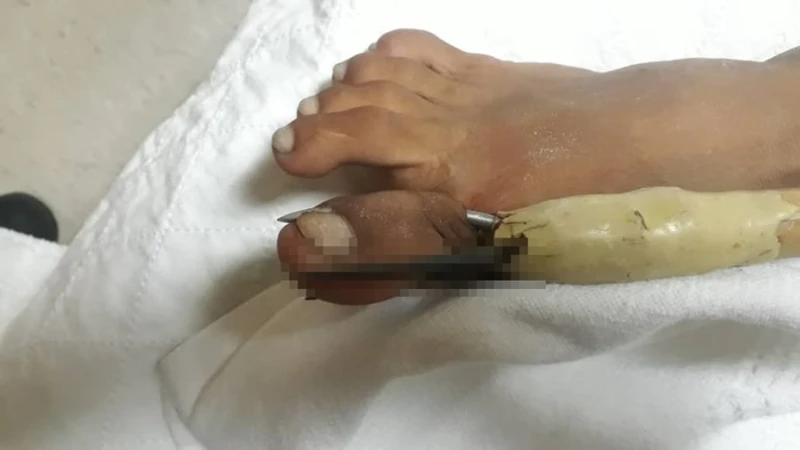 下海摸螃蟹   男慘遭鋼魚叉刺傷