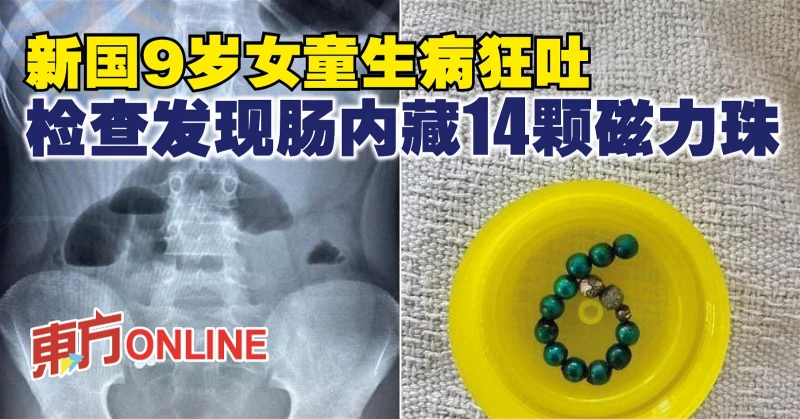 新國9歲女童生病狂吐　檢查發現腸內藏14顆磁力珠