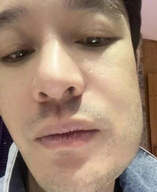 黃曉明拔智齒臉腫成方形　網笑瘋：變方小明了