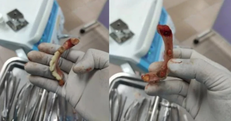 假牙醫裝「假牙」 男子貪便宜賠上全牙