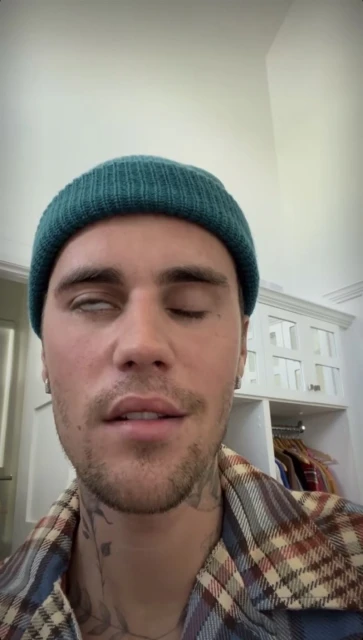 驚爆罹罕病右臉麻痹翻白眼　小賈斯汀臉歪嘴斜病容曝光