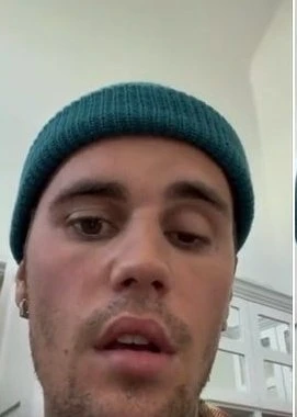 驚爆罹罕病右臉麻痹翻白眼　小賈斯汀臉歪嘴斜病容曝光