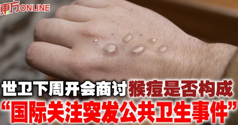 世衛下周開會商討　猴痘是否構成「國際關注突發公共衛生事件」