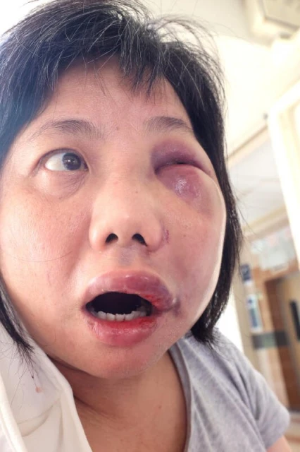 一聲「喂」惹禍上身　女送餐員遭同行暴打