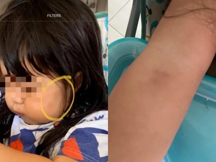 2歲女童臉手被老師捏瘀青　幼兒園方：互動與玩笑