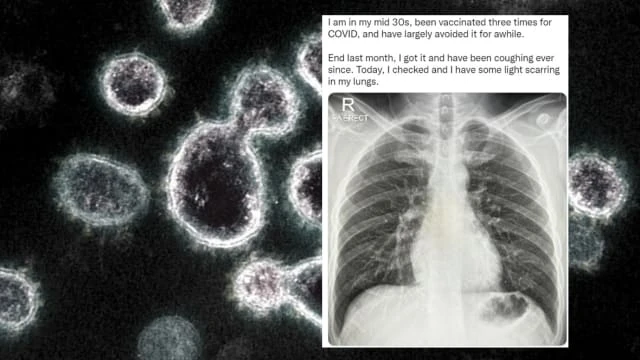 已接種三劑疫苗確診時咳不停 馬國男子肺部輕微結疤