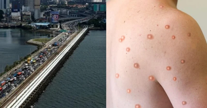 新加坡驚傳首宗猴痘病毒    大馬嚴密監督馬新邊境訪客