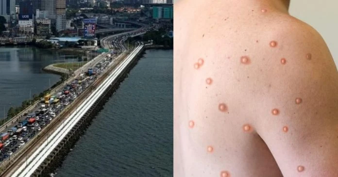 新加坡驚傳首宗猴痘病毒    大馬嚴密監督馬新邊境訪客