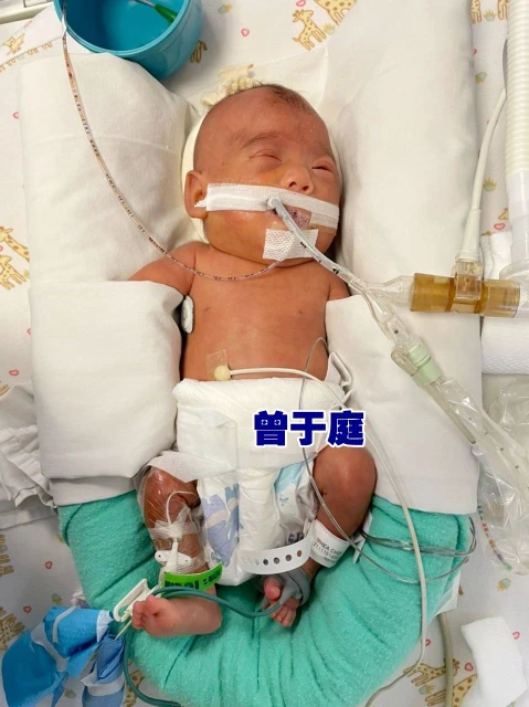 雙胞胎女嬰心臟有孔　急籌8萬醫費