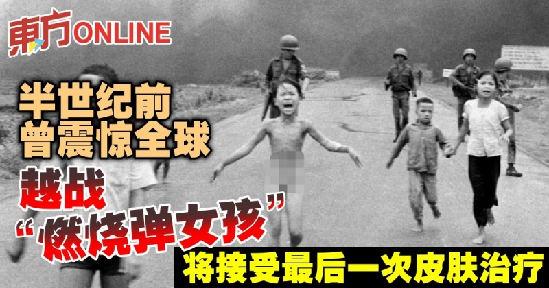 越戰「燃燒彈女孩」　將接受最後一次皮膚治療