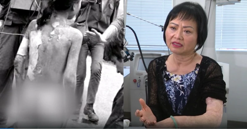 越戰「燃燒彈女孩」　將接受最後一次皮膚治療