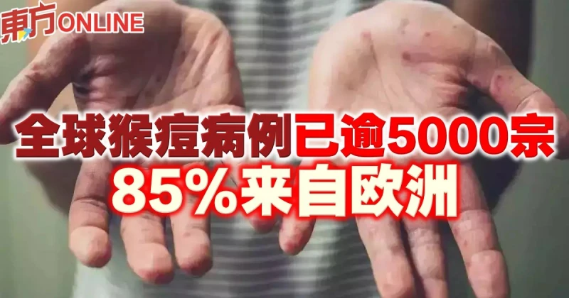 全球猴痘病例已逾5000宗　85%來自歐洲
