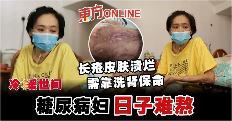 長瘡皮膚潰爛…需靠洗腎保命​​　糖尿病婦盼大眾伸援