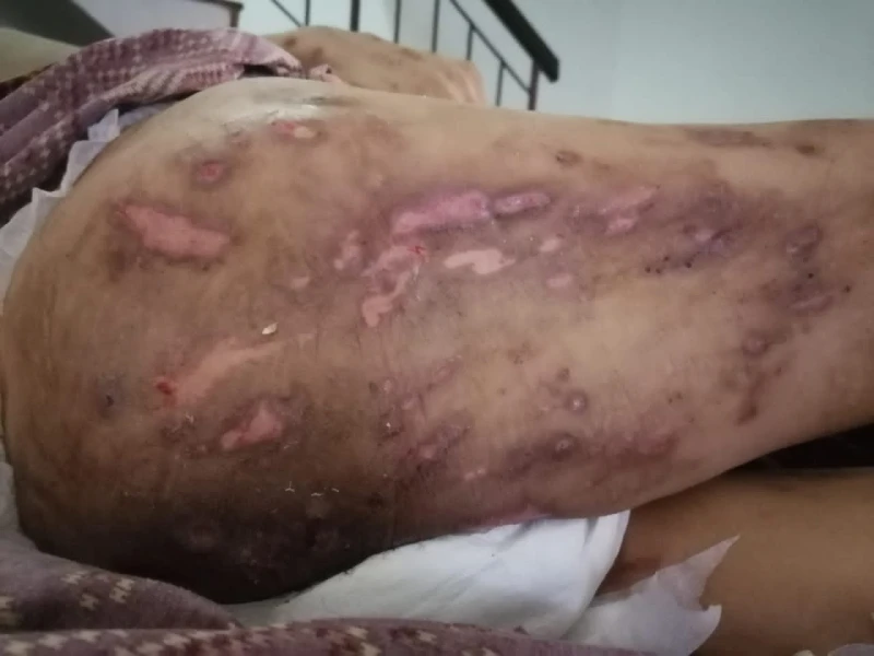 長瘡皮膚潰爛…需靠洗腎保命​​　糖尿病婦盼大眾伸援