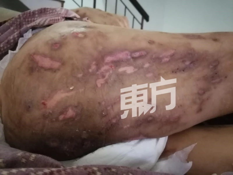 患嚴重糖尿病經濟陷困 華裔女皮膚潰爛靠洗腎保命​​