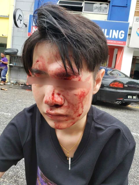 轎車與摩哆小擦撞 華青道歉反遭頭盔砸至骨裂