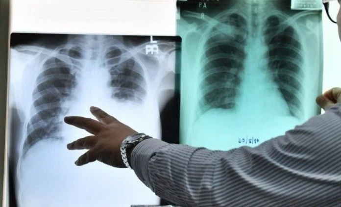 呼吸道感染病例再增4宗　多為學生