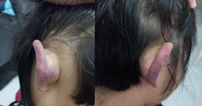 女童被大力扭耳朵致淤青　家長還被笑「沒好好監督孩子」