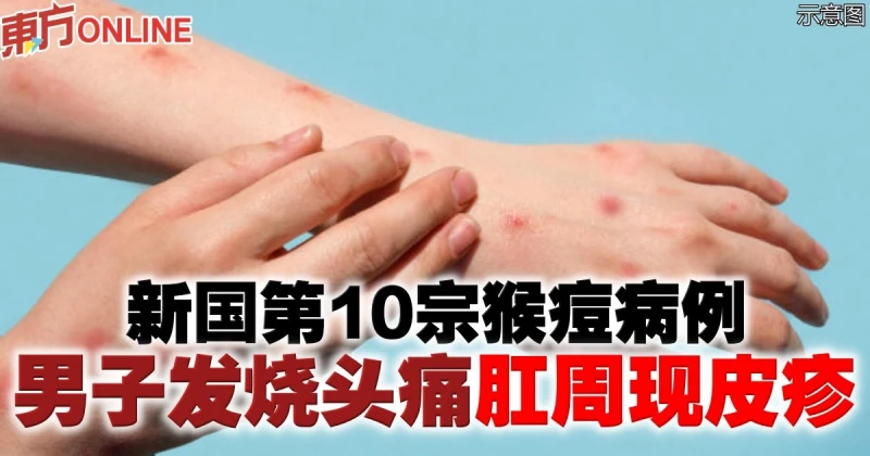 新國第10宗猴痘病例　男子發燒頭痛肛周現皮疹