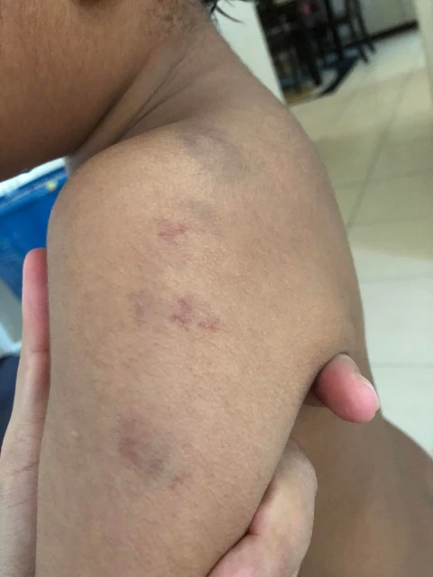 疑自閉兒遭特殊教育中心虐待 　母討說法不果報警