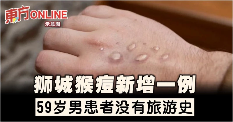 獅城猴痘新增一例　59歲男患者沒有旅遊史