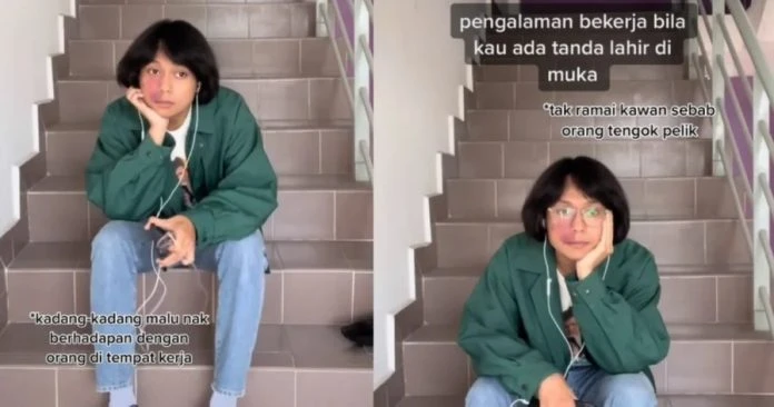 臉上有胎記屢被嘲笑　青年申請前台工作多次被拒